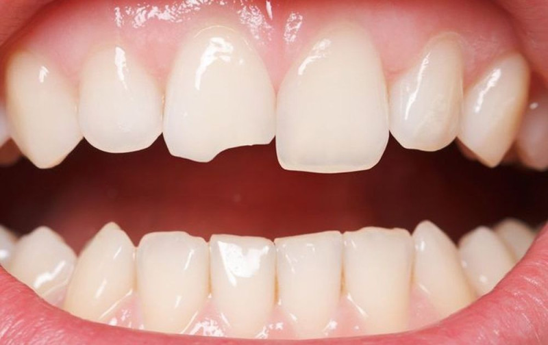 Răng bị mẻ - Nỗi ám ảnh của nụ cười và cách khắc phục hiệu quả